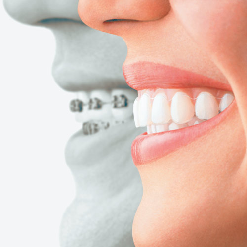 The smile of a woman wearing Invisalign